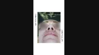 جراحی قوز بینی