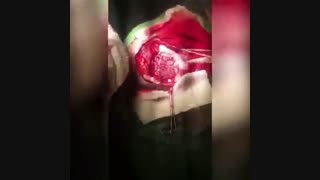 جراحی خارج کردن کانون تشنج