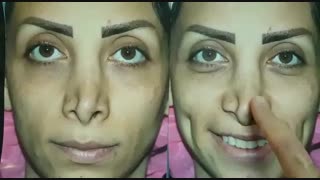 عمل ترمیمی بینی برای اصلاح انحراف شدید | دکتر ابراهیمی