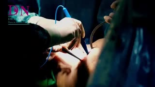 فیلم تعویض پروتز سینه