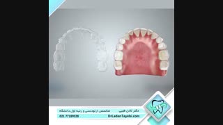 مزایای ارتودنسی نامرئی (اینویزالاین) | دکتر لادن طیبی ارتودنسی