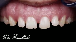 نمونه اجرای  ویدیویی قبل و بعد درمان | راهنمای لبخند