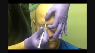 تزریق بوتاکس جهت درمان میگرن