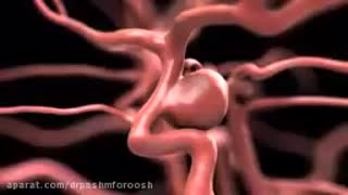 جراحی بسته انوریسم های مغزی