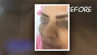نمونه کار جراحی زیبایی بینی
