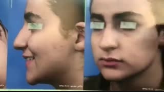 عمل بینی گوشتی