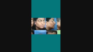 فیلم جراحی بینی