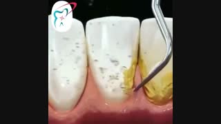آیا شما به جرمگیری دندان احتیاج دارید ؟