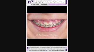ترکیب ارتودنسی و جراحی فک | دکتر فاضل فیروزی
