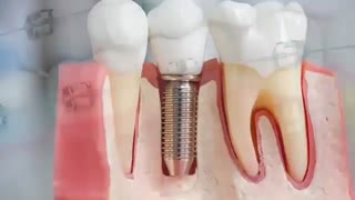 آیا ارتودنسی با وجود روکش، ایمپلنت امکان پذیر است؟ | دکتر قریشی