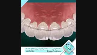 نگهدارنده ثابت ارتودنسی | دکتر لادن طیبی اصلاح فرم صورت