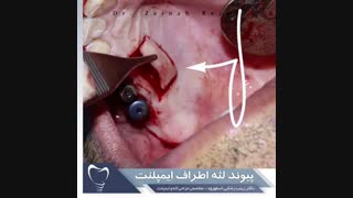 پیوند لثه اطراف ایمپلنت | دکتر زینب رضایی اسفهرود تزریق چربی