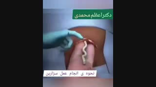 فیلم شماتیک زایمان سزارین