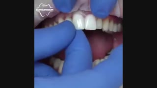 لمینت دندان | دندانستان