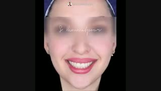 اثر فضای خالی و تیره گوشه دهان بر روی جذابیت لبخند | دندانستان