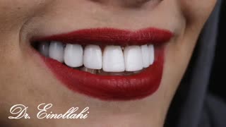 اصلاح طرح لبخند با استفاده از کامپوزیت ونیر | دندانستان