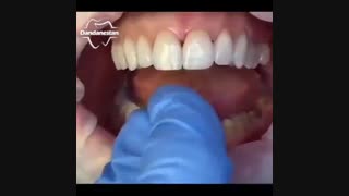 لمینت دندان | دندانستان