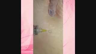 مزو و میکرونیدلینگ جهت رفع چروک ناشی از بارداری