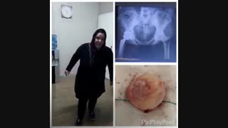 عملیه استبدال مفصل الحوض الیمنی