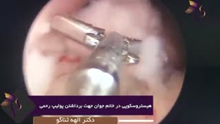 هیستروسکوپی پولیپ رحم