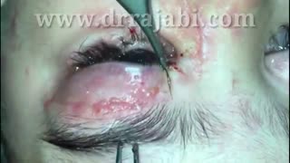 بازسازی پلک بالا و پایین پس از تصادف