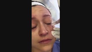 دستگاه میکروندیلینگ دکتر پن