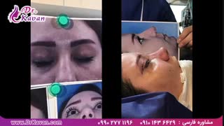 عمل همزمان زیبایی پلک و بینی توسط دکتر کاوان