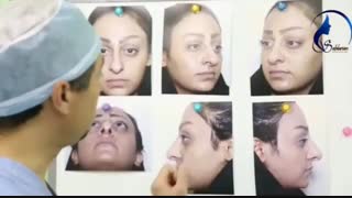 فیلم واقعی جراحی بینی گوشتی