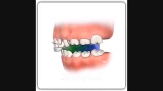دستگاه فانکشنال ارتودنسی | دکتر سعید قریشی