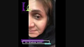 فیلم تزریق فیلر زیر چشم کاشت ریش