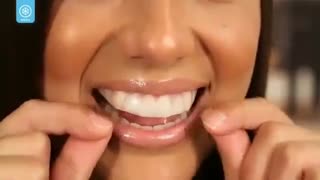 کیت بلیچینگ درخانه | دکتر معصومه عطوفی کامپوزیت ونیر