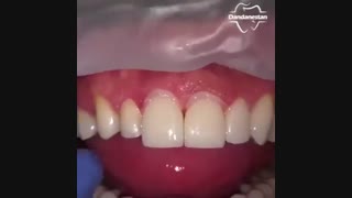 لمینت دندان | دندانستان