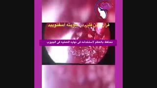 ورم خبیث فی الانف