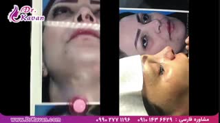 عمل بینی توسط دکتر کاوان