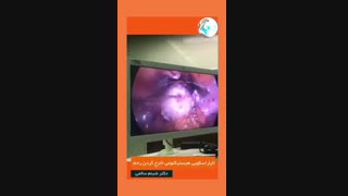 لاپاراسکوپی هیسترکتومی خارج کردن رحم