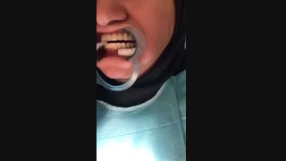 ایمپلنت دو فک بالا و پایین