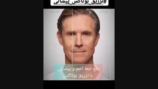 رفع خط اخم پیشانی با تزریق بوتاکس