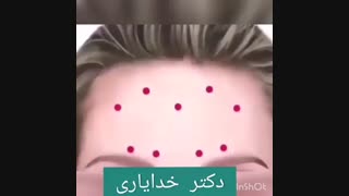 تزریق بوتاکس برای از بین بردن خط پیشانی و خط اخم