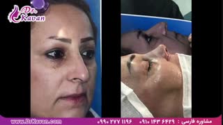 عمل بینی توسط دکتر کاوان