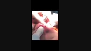 عوارض ژل لب ارزان