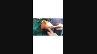 لیفت اندوسکپیک پیشانی مزوتراپی