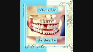 فیلم ایمپلنت دندان