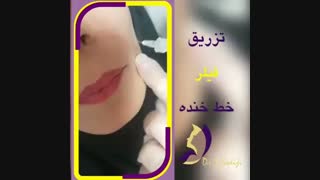 فیلم تزریق فیلر خط خنده