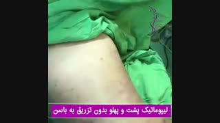 فیلم لیپوماتیک شکم و پهلو