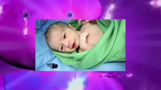 عمل زایمان سزارین