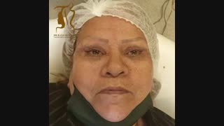 بلفاروپلاستی