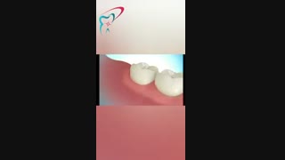 جراحی چند مدل از دندان عقل