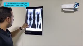 بهترین راه درمان پاهای پرانتزی (ژنوواروم)