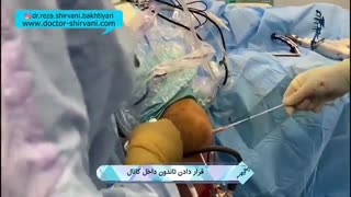 فیلم عمل درمان پارگی رباط صلیبی زانو