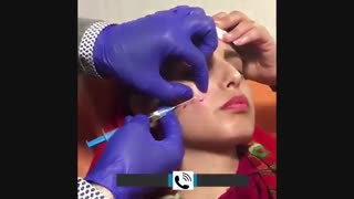 از بین بردن جای جوش با بایوفیلر